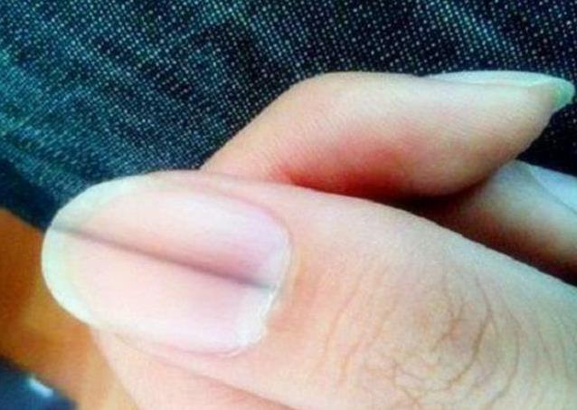 指甲冒黑线不疼不痒，忽视半年后查出大问题，你还敢拖？