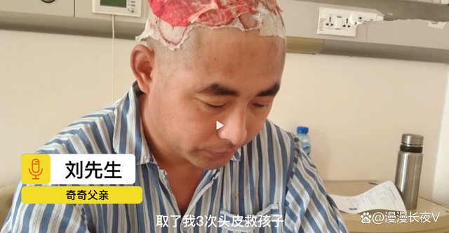 爸爸三次取头皮救治重度烧伤的儿子，还要面对巨额治疗费用