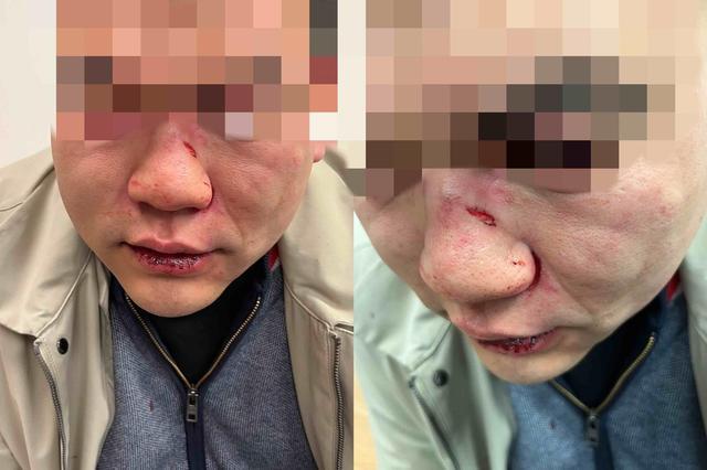 中国男子在伦敦遇袭被打至眼眶骨折 嫌凶已被保释