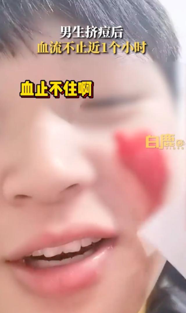 男生挤痘后流血近一小时 无论痘痘处于哪个阶段，都不建议大家自行挤压