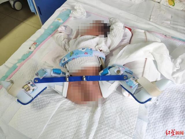 新生儿大腿被医生掰骨折，家属索赔60余万 院方：诉求已经超出医院上限