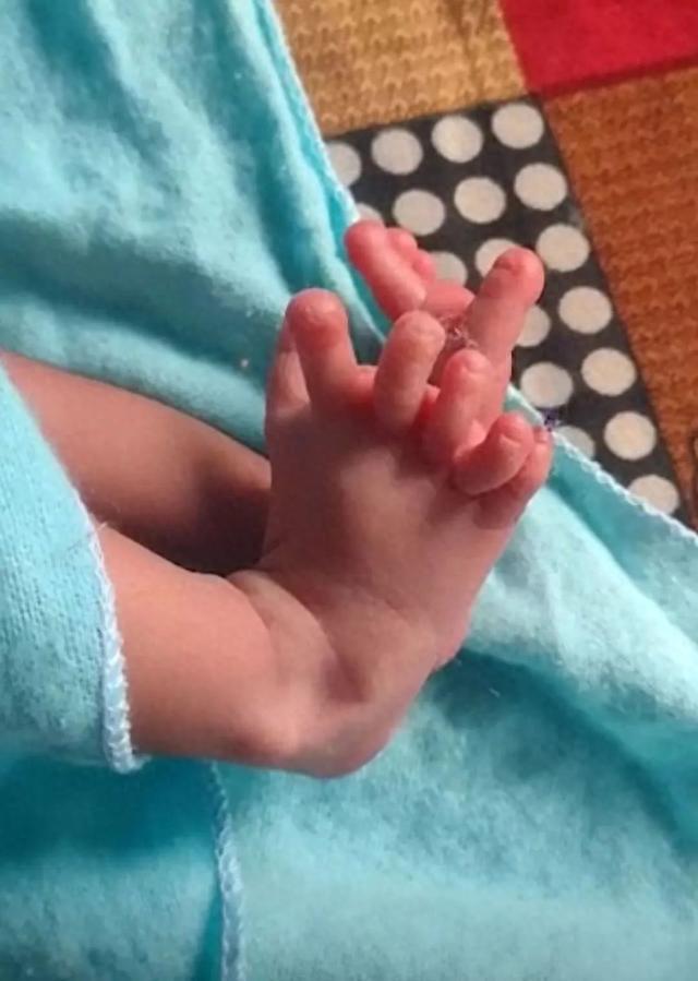 印度一女婴出生有26个手指脚趾，家人认为她是女神转世