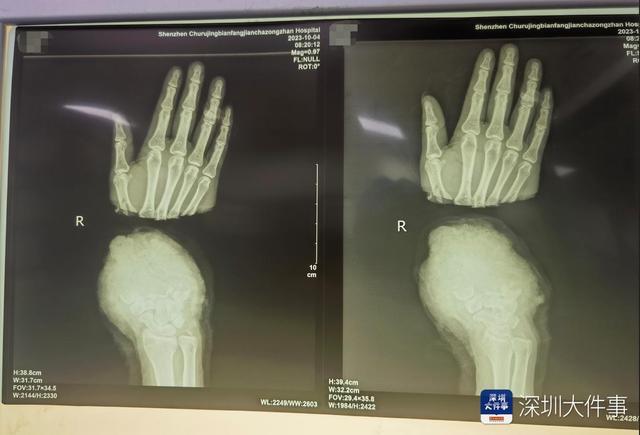 工人手掌被切断医生接回 手术耗时近7小时成功缝合