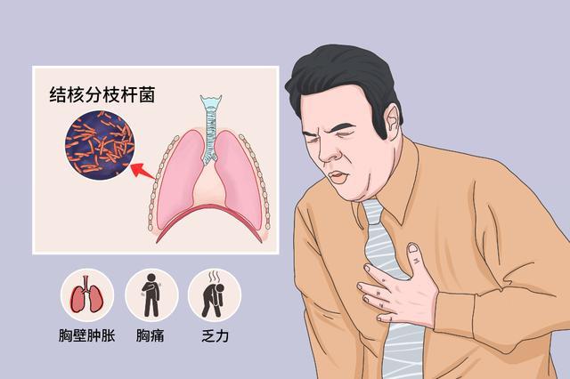 男子胸疼得睡不著覺病因是結核桿菌醫護團隊抽絲剝繭找兇手2