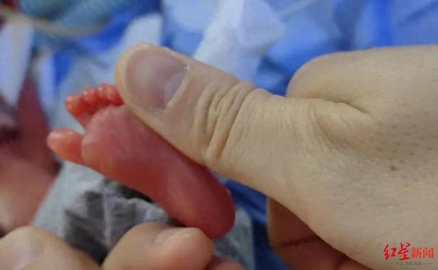 出生仅700余克巴掌宝宝平安出院 超早产奇迹存活