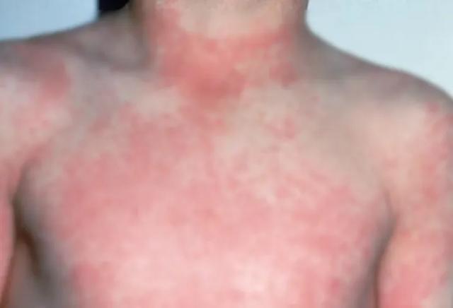 桃子绒毛可能导致水肿皮疹 猩红热防范需知