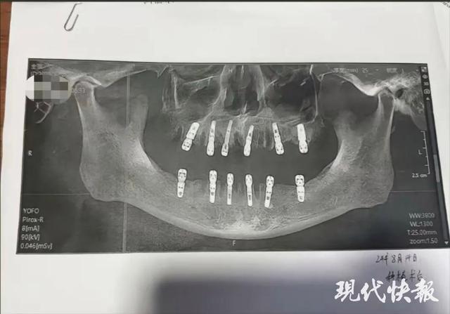 男人一次拔牙23颗种12颗13天后示寂 医疗纠纷引热议