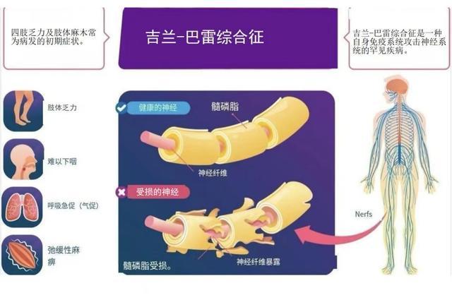 大学生因一顿烧烤进ICU换了5次血 不洁食物激发免疫反应