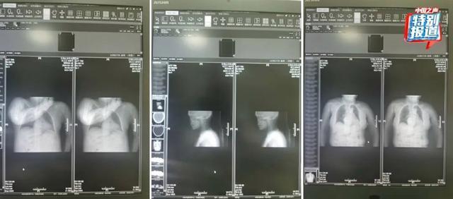 医生实名举报医院涉嫌骗保已立案 影像造假牵出骗保链