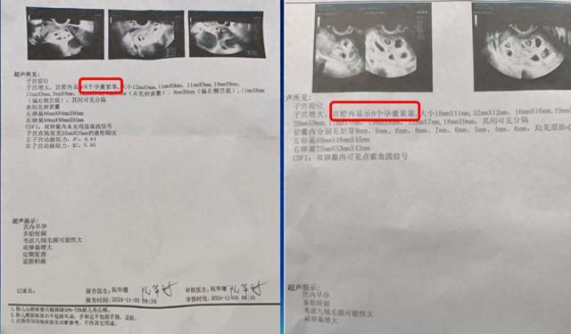 女子打促卵针怀9胞胎 医生：必须减胎；从3胞胎到9胞胎的惊喜与挑战