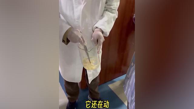 女子体内排出10米长寄生虫