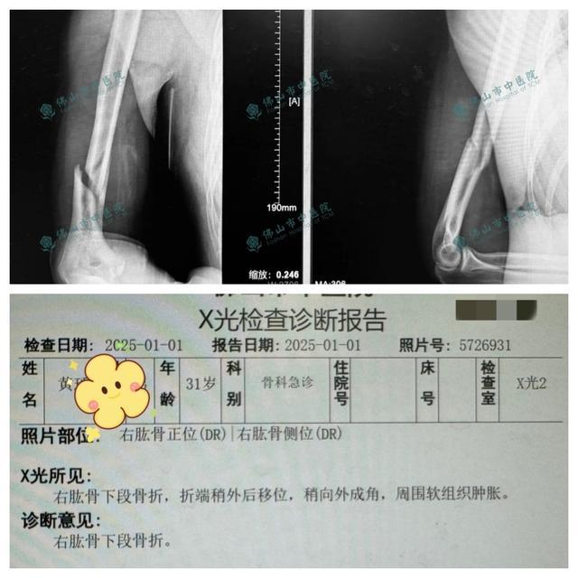 两小伙与机器人掰手腕当场骨折 游乐设施力量惊人