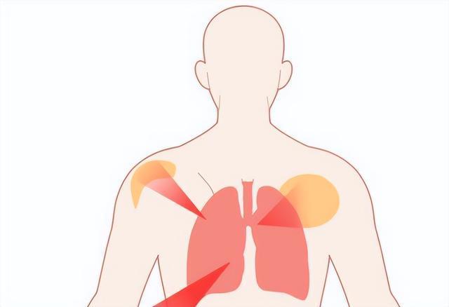 肺癌一查就是晚期,？其實大腿早給了暗示,！有這幾個癥狀，盡早檢查 警惕腿部異常信號
