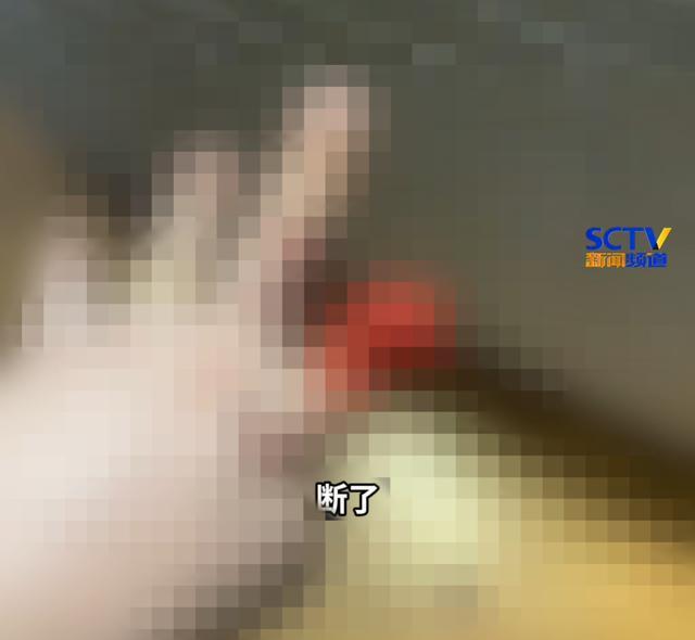 男子喂食人鱼被咬掉手指无奈接脚趾 视频曝光引发热议