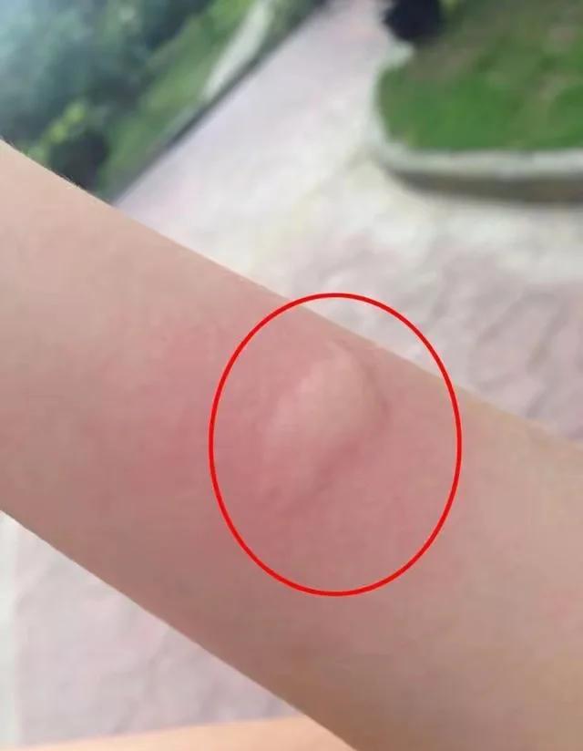 O型血的人更容易被蚊子咬吗？