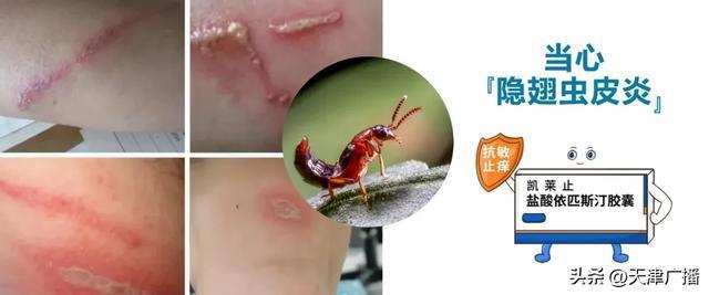 天津多名网友发现隐翅虫 警惕毒液危害