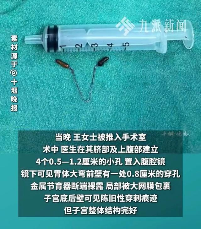 46岁女子腹痛3天就医 因10余年前的节育器异位