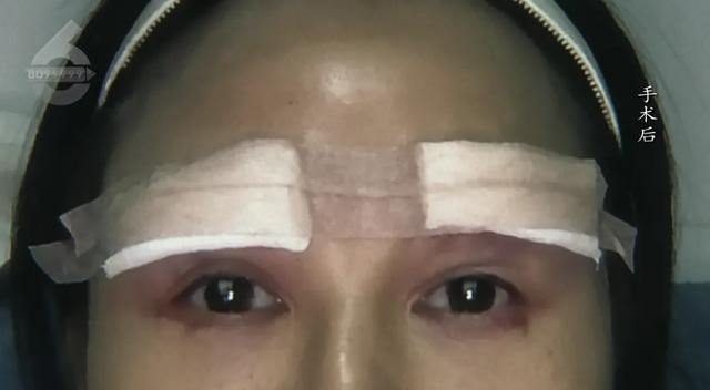 4万整形还不如术前 院方回应 顾客不满效果要求赔偿