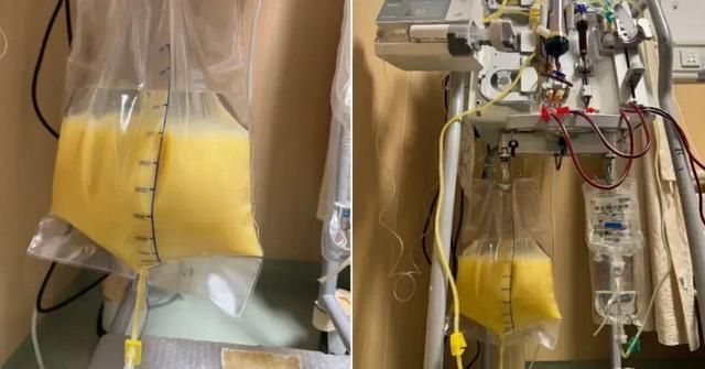 女子炫完小龍蝦又吃冰西瓜被送進(jìn)ICU 高脂飲食成誘因