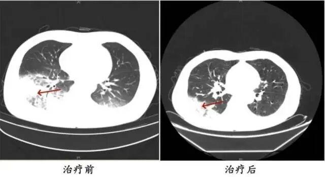 不洗空調(diào)老人被吹出白肺高燒不退 警惕軍團(tuán)菌感染