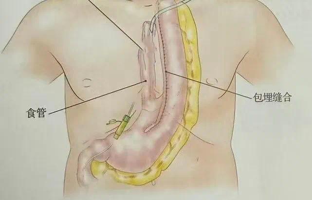 87岁老人误服管道疏通剂 西安国际医学中心医院专家助其重拾希望