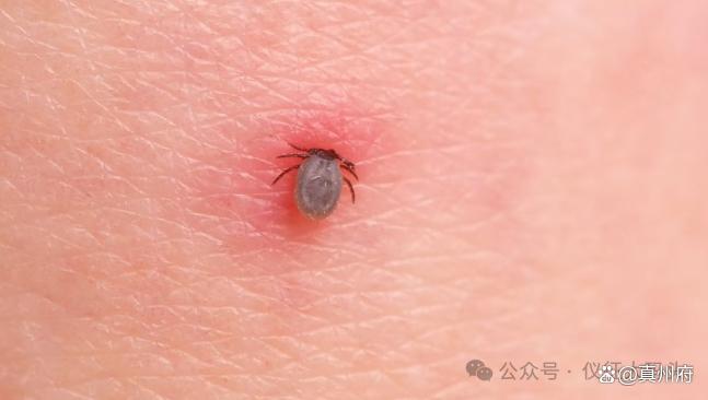 大媽戶外勞作后高燒不退確診蜱蟲病 警惕新布尼亞病毒感染