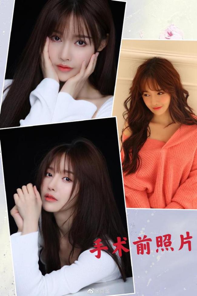 女演员高溜整容失败鼻子坏死 并面临200万违约赔偿