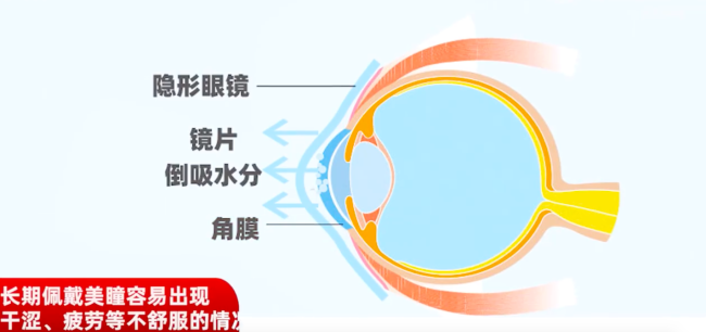 戴美瞳会把泪膜一分为二