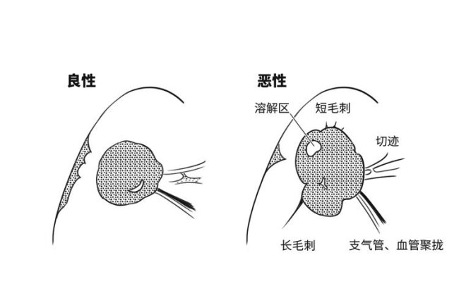 牛肉是“结节催化剂”？提醒：不想结节恶化，尽量少吃4种食物