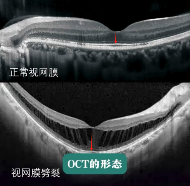 从“失控”到可控：后巩膜加固术阻击高度近视眼底病变