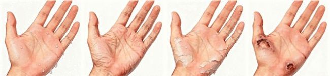 ˫�ֳ��ꡰʪ����������ֻ���ǡ������������������ֺ�֢������