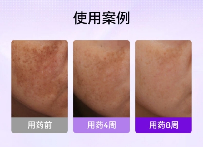 面对"斑中之王"黄褐斑,孚立美®让治疗思路有了新可能