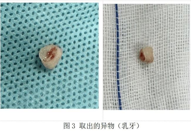 春节儿童气道异物防护指南，家长必看！