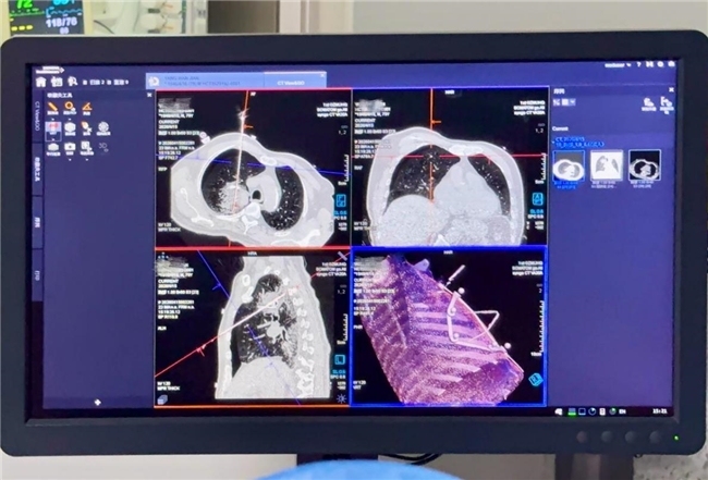 一针直达16厘米深病灶：横琴首例机器人肺穿刺手术见证琴澳医疗一体化发展