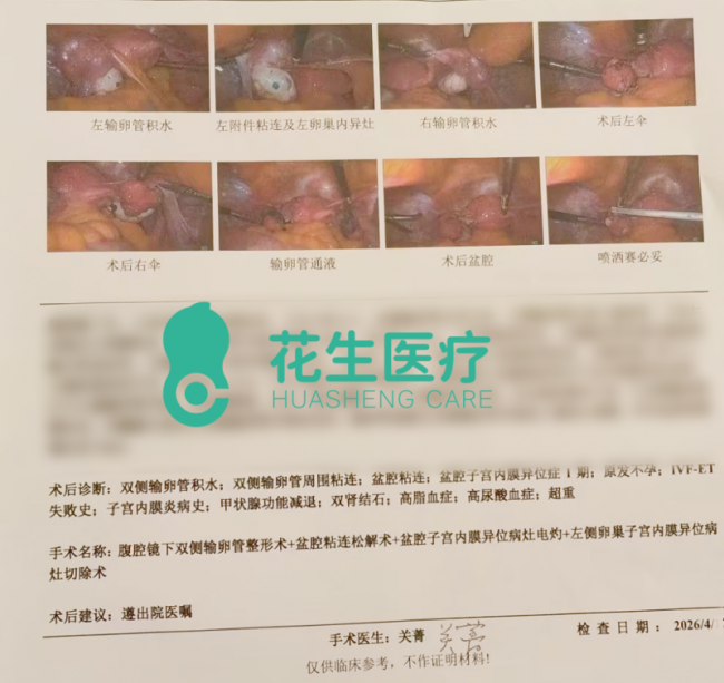 输卵管积水致试管成功率降50%，花生腔镜修复术为生育保希望