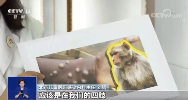 台湾地区首次出现本地猴痘确诊病例，为两名男子 该如何预防？
