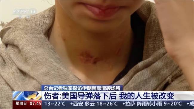 伊朗13岁女孩被美军在脸上留疤 战争伤痕难愈合