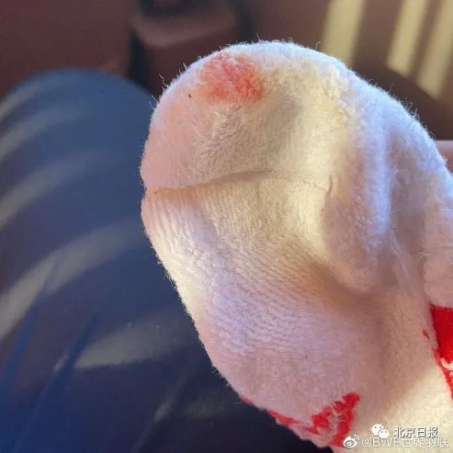 奥运冠军陈雨菲全运会穿李宁鞋比赛 脚被割伤