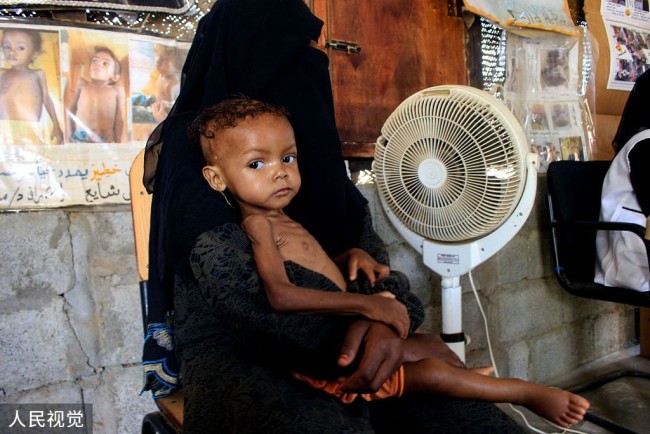 彩票计划最准的软件_联合国报告称也门面临严重饥荒 孩童骨瘦如柴