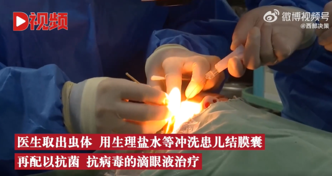 2岁男童眼睛现4条寄生虫游动，患儿曾有过犬类密接史