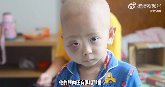 5岁男童患癌头部变形吓哭自己