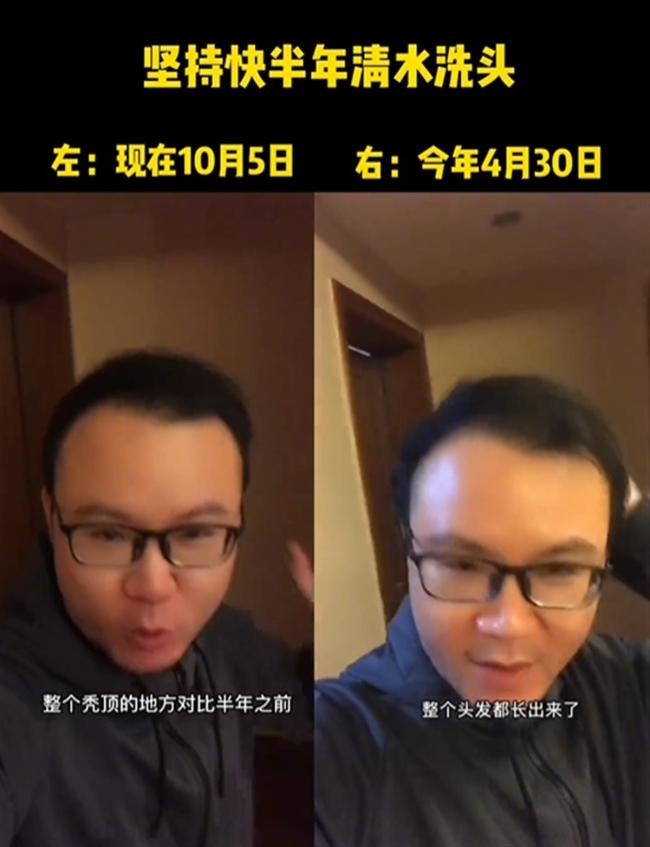男子回应“不用洗发水秃顶变满头黑发”：网友理解有偏差