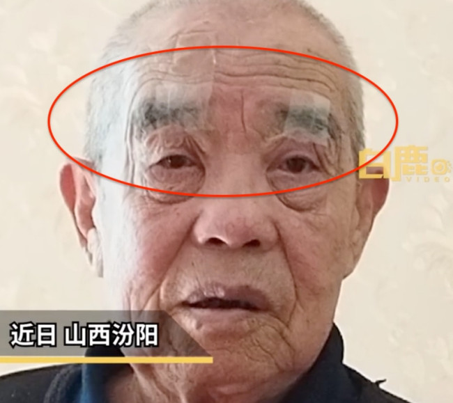 奶奶用胶带帮老伴提拉下垂眼皮