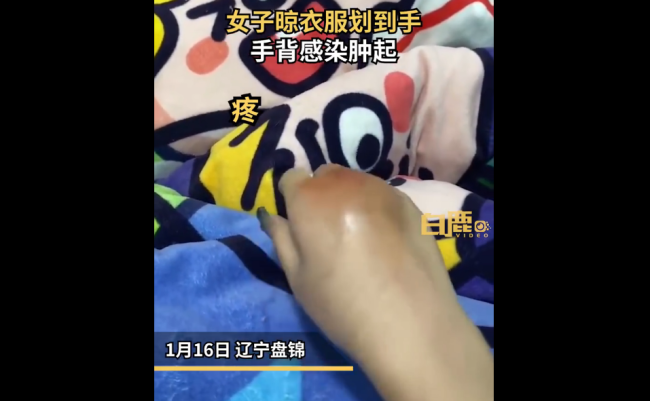 女子手被铁架划伤未在意次日肿成球