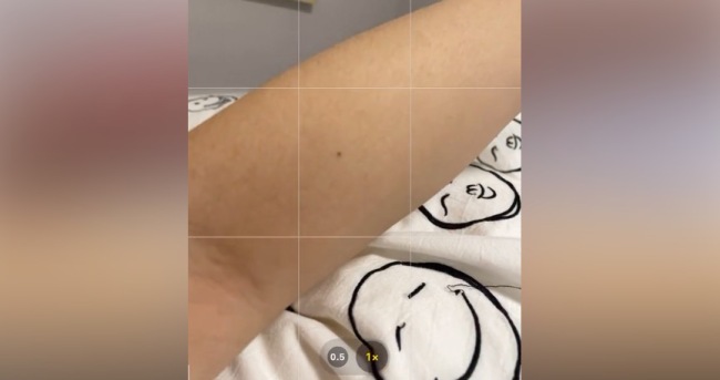 网友集体晒出左臂的痣