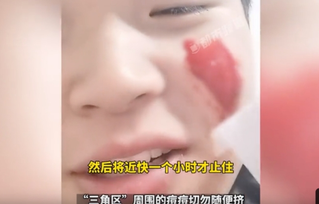 男生挤痘后流血近一小时：血量多时喷射出来