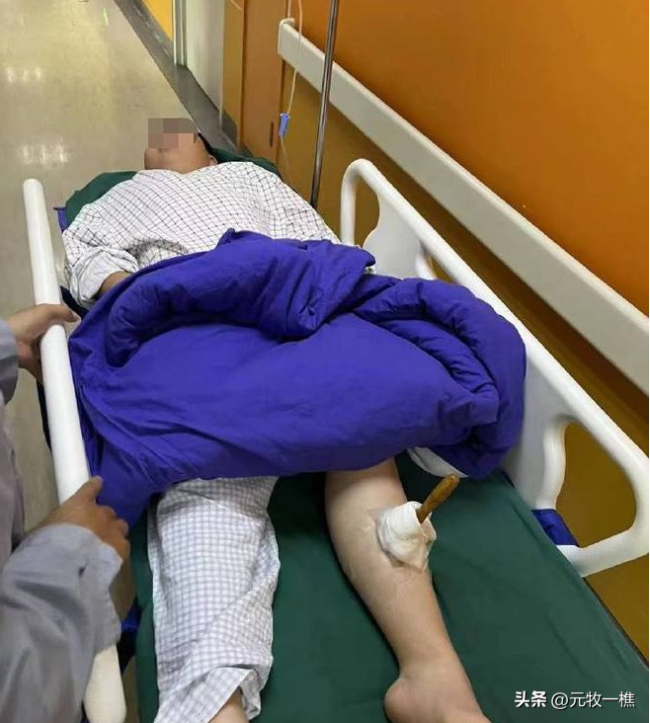 丧心病狂！男孩被同学用铁锥扎小腿 整根几乎没入腿部需全麻取出