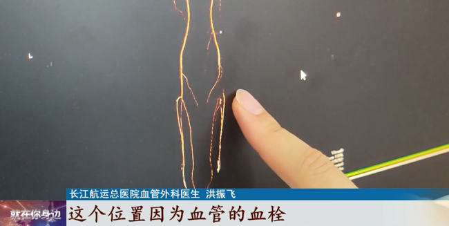 男子吃喝无度突发“腿梗”,导致下肢持续胀痛、麻木