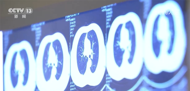 早发现早治疗！这些肺癌高危者最好每年做一次CT