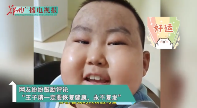患病男孩肿成馒头脸仍笑对生活他说:“爱笑的人运气不会太差”